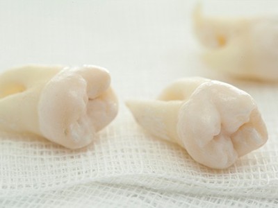 智齒疼了，這牙非拔不可嗎？