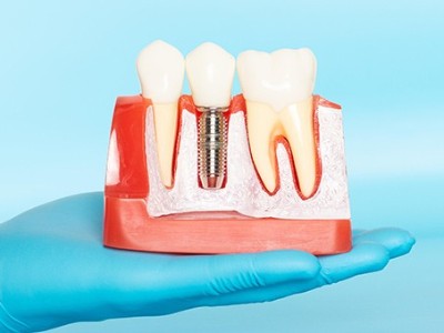 種牙VS鑲牙，你適合哪種?
