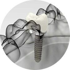 術前研究、模擬提升種植成功率