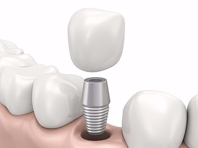 在承德哪家口腔醫(yī)院口腔種植齒好一點，惟德口腔醫(yī)院值得您的選擇