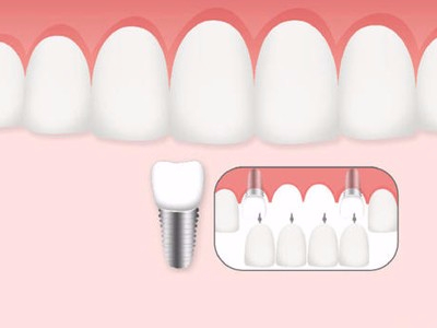 惟德口腔口腔種植怎么樣？惟德口腔就來(lái)為您一一解答