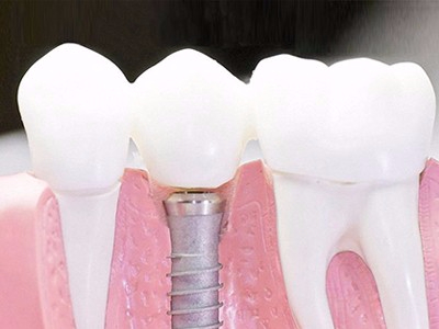 在承德口腔種植齒需要多少錢？惟德口腔一一為您道來(lái)